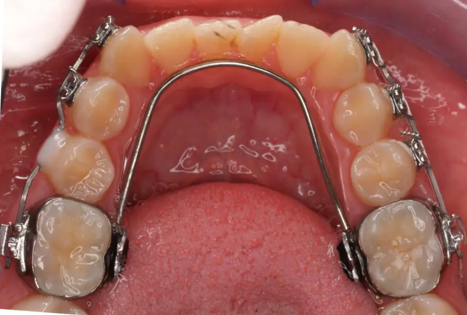 cleaning teeth with braces