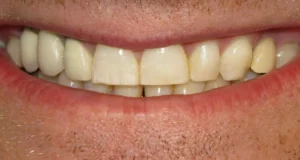 teeth whitening solutions