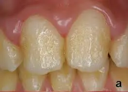 teeth whitening solutions 