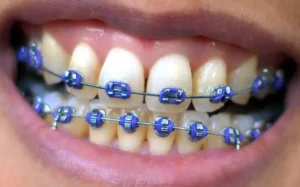 cleaning teeth with braces