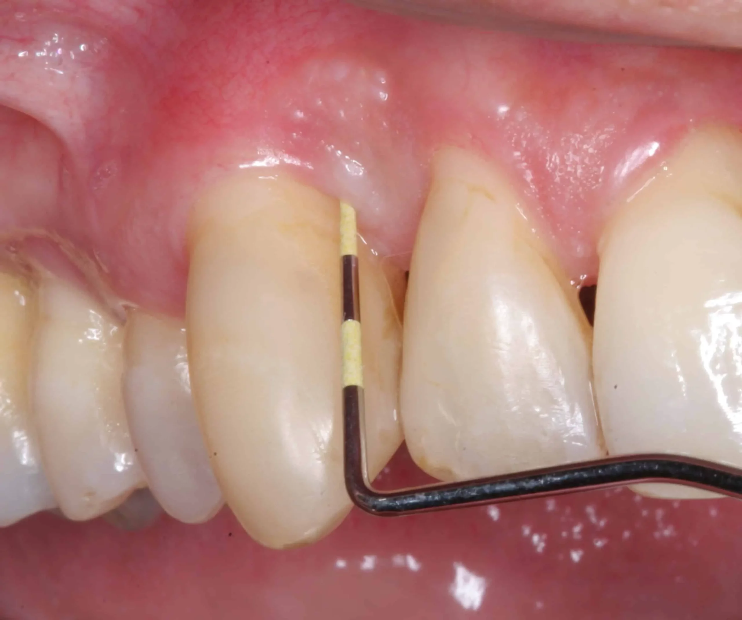 what can i do about gum disease