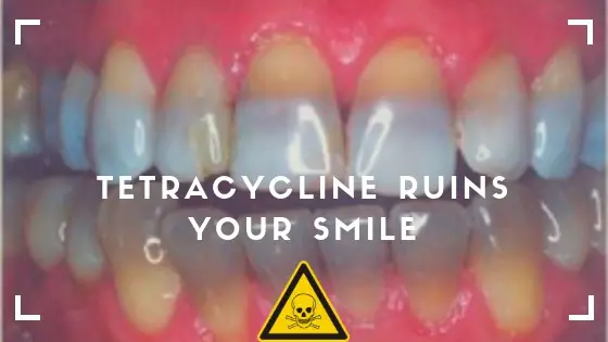 does tetracycline stain teeth