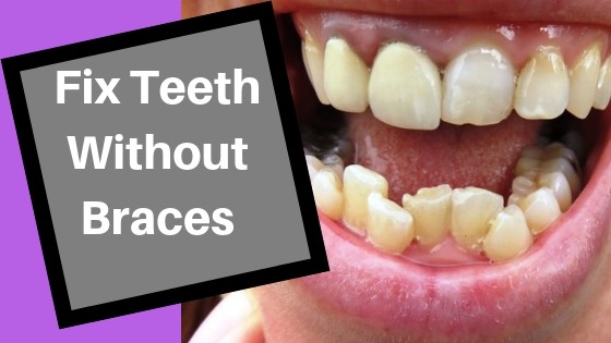how to fix crooked bottom teeth without braces