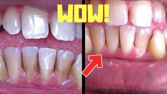 how to remove brown stains on teeth