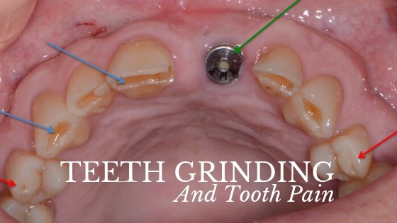 can grinding teeth cause tooth pain
