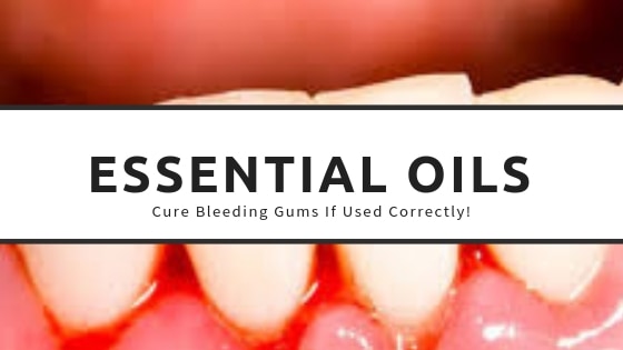 Using essential oils for bleeding gums