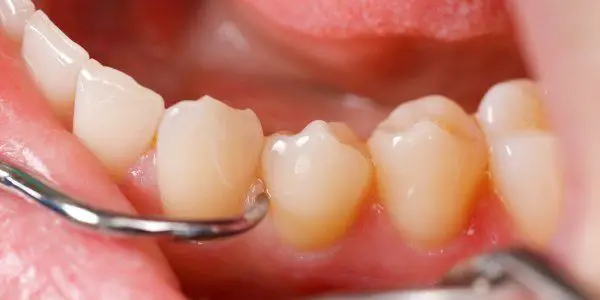 can a dentist remove tartar