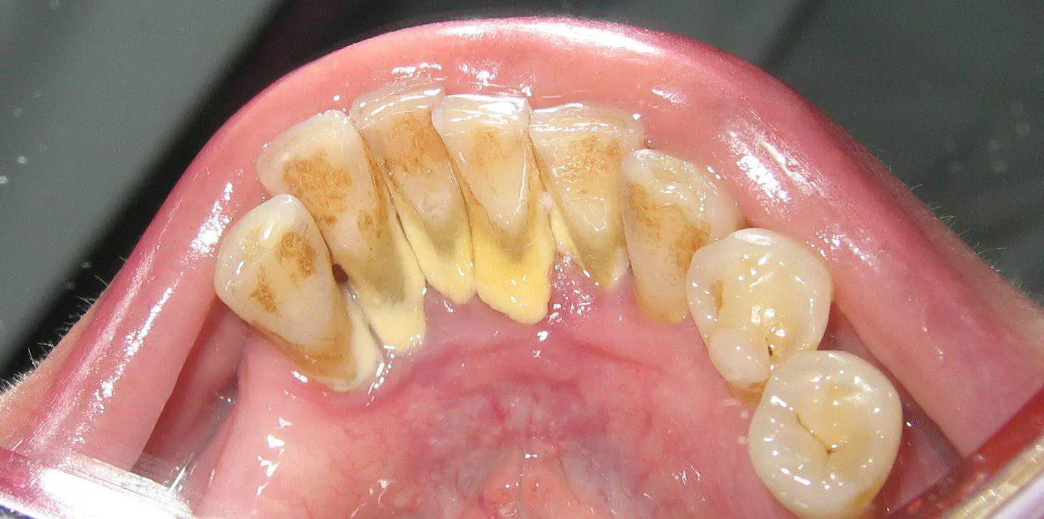 can a dentist remove tartar