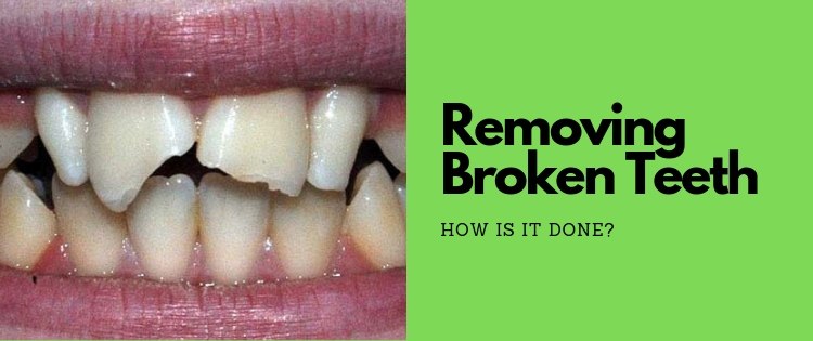 how do dentists remove broken teeth