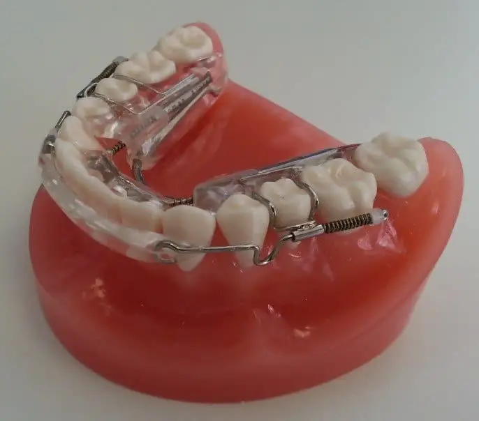 Inman aligner option for teeth straightening