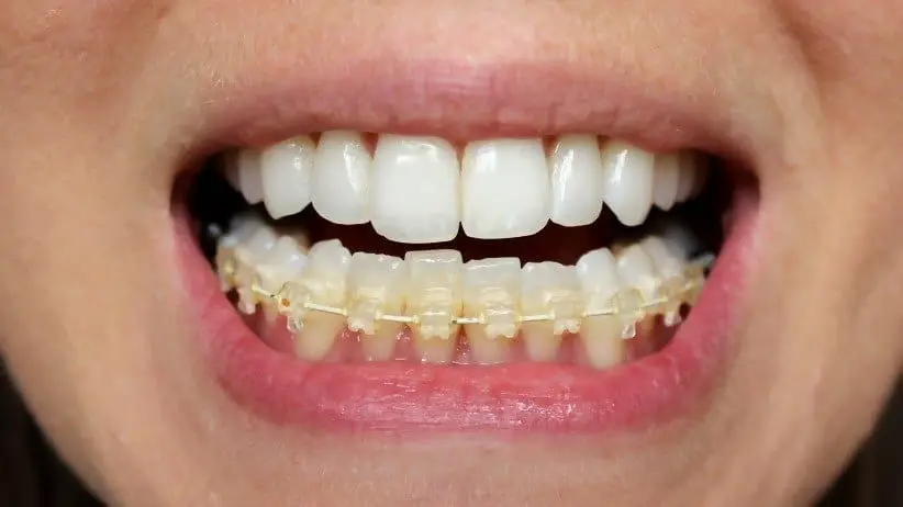 six month smiles teeth straightening for adults