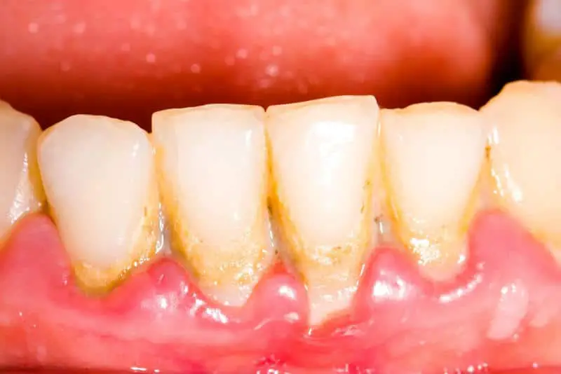 why do teeth go yellow