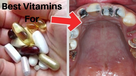 Best Vitamins For teeth and gums