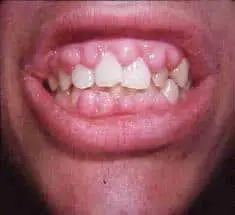 gum bleeding when flossing around one tooth