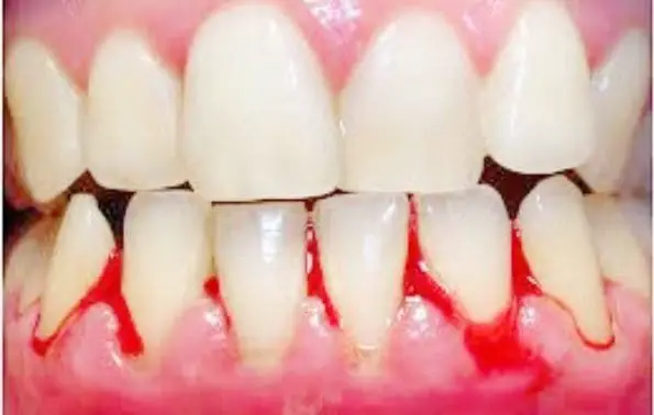 gums bleeding around one tooth when flossing