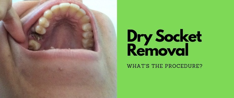 how does a dentist treat dry socket