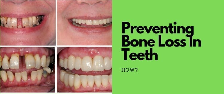 how to prevent bone loss in teeth