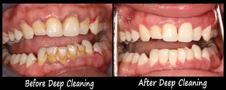 can dental cleaning damage teeth