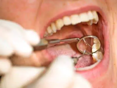 can dental cleaning damage teeth