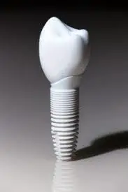 different types of tooth implants