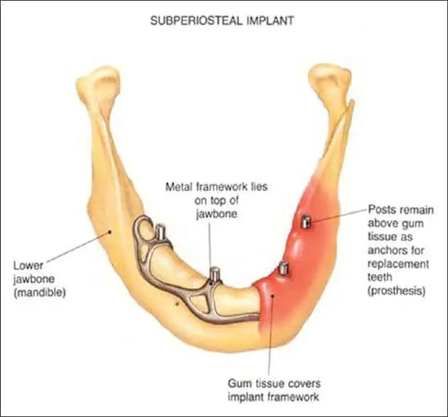 different types of tooth implants