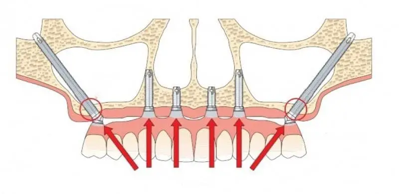 different types of tooth implants