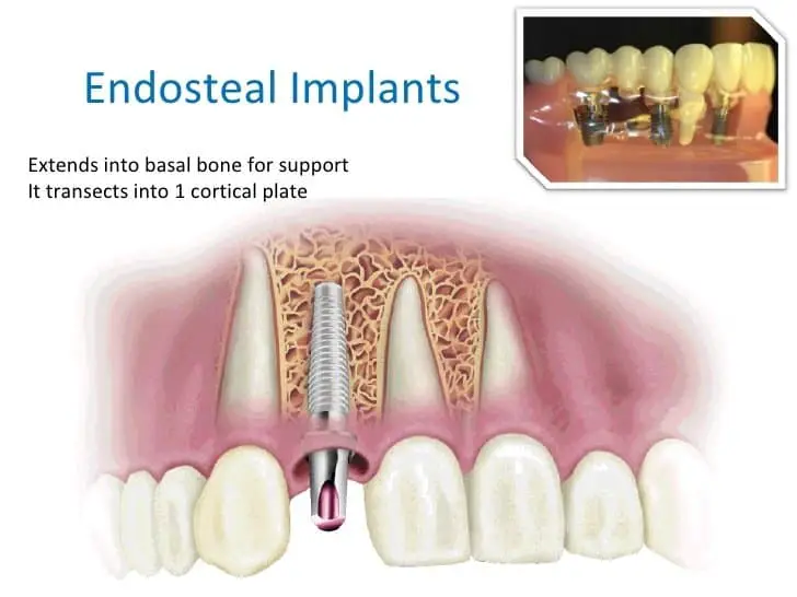 different types of tooth implants