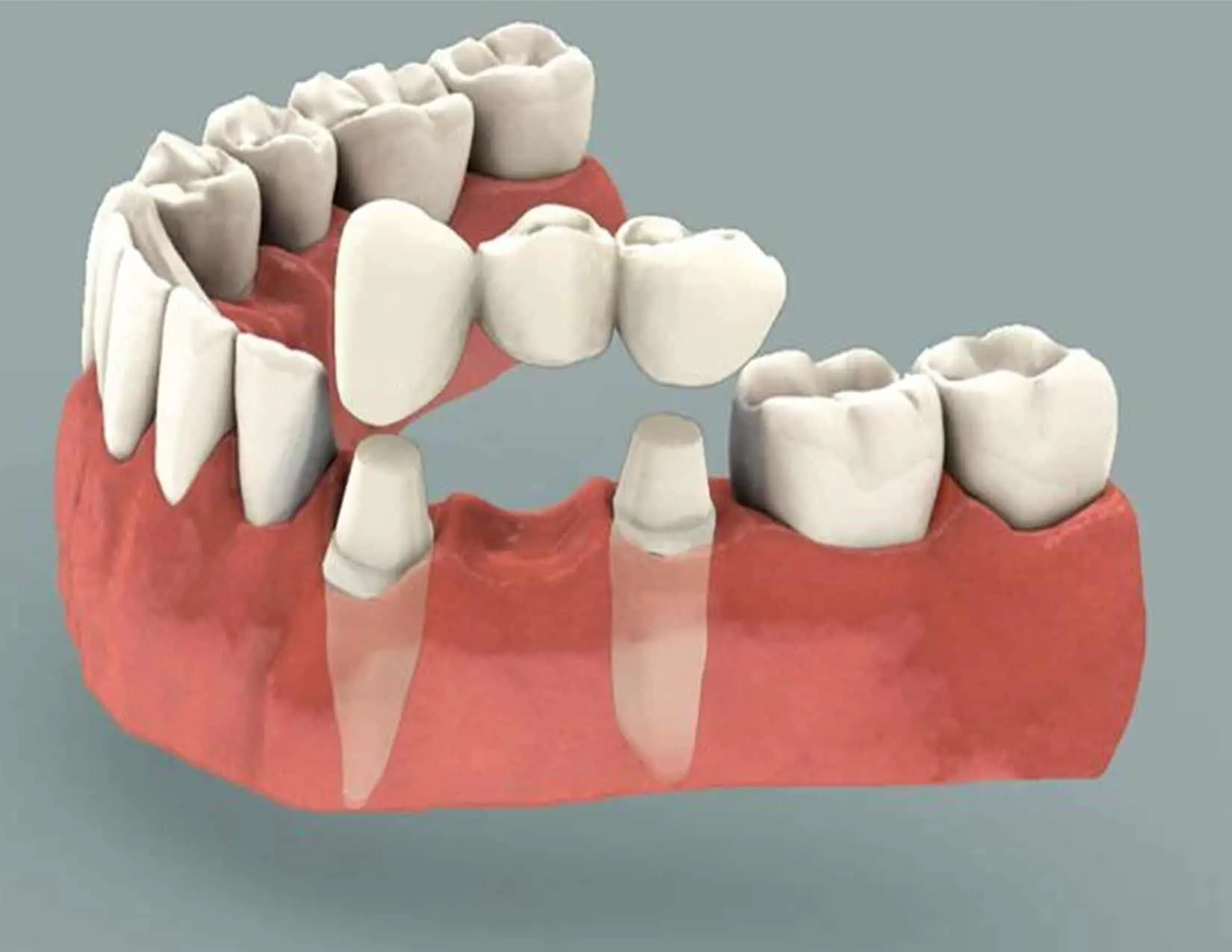 different types of tooth implants