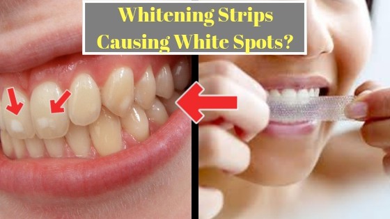 white spots on teeth from whitening strips