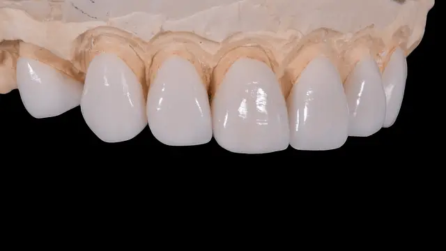 Can Teeth Fall Out After Deep Cleaning