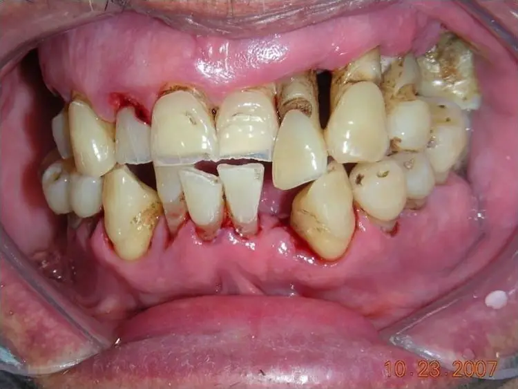 best treatment for gum disease