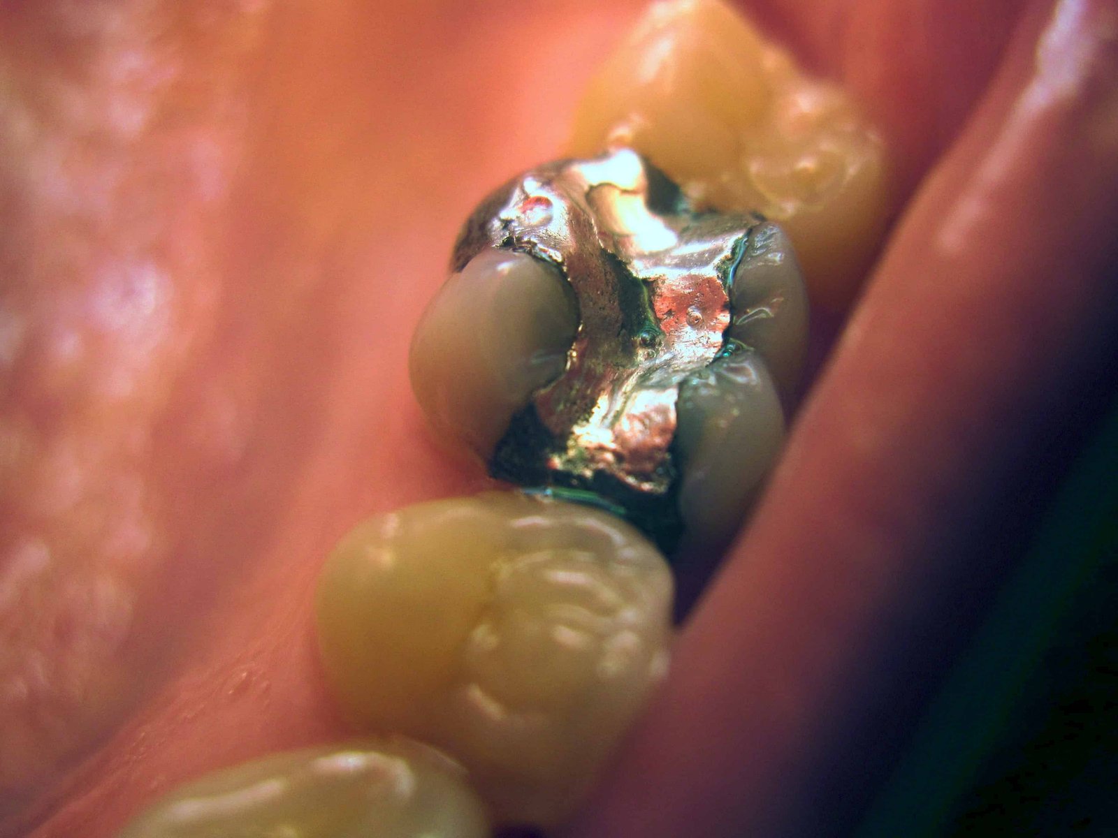 amalgam fillings dangerous