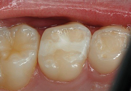 amalgam fillings dangerous