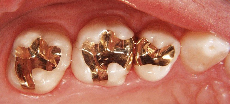 amalgam fillings dangerous