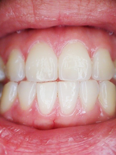 How Long To Leave Fluoride Varnish On Teeth?