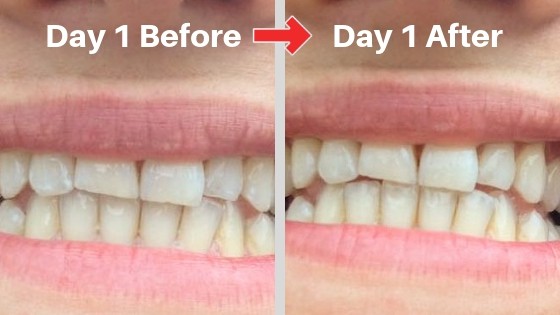billionaire teeth whitening kit review day 1