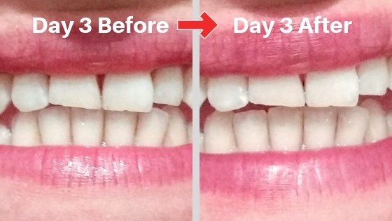 billionaire teeth whitening kit review picture day 3