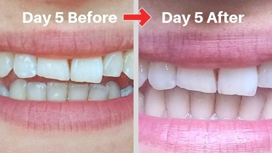 billionaire teeth whitening kit day 5 results