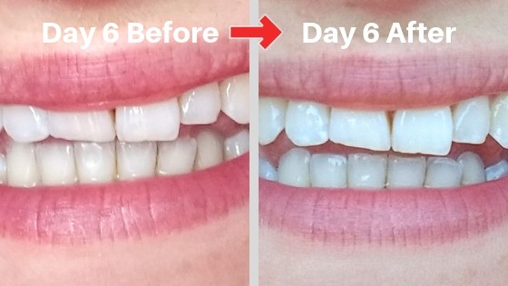 billionaire teeth whitening kit day 6 results