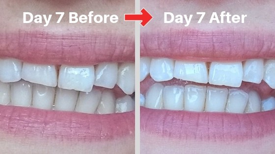 billionaire teeth whitening review picture 7