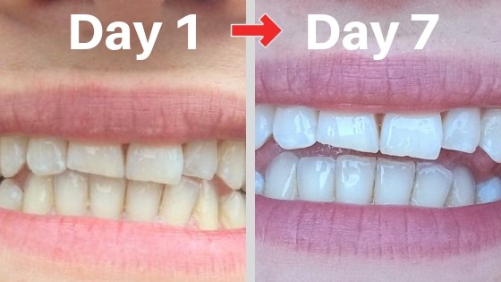 billionaire teeth whitening kit comparison pictures