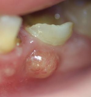 Cure tooth abscess naturally
