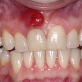 Cure tooth abscess naturally