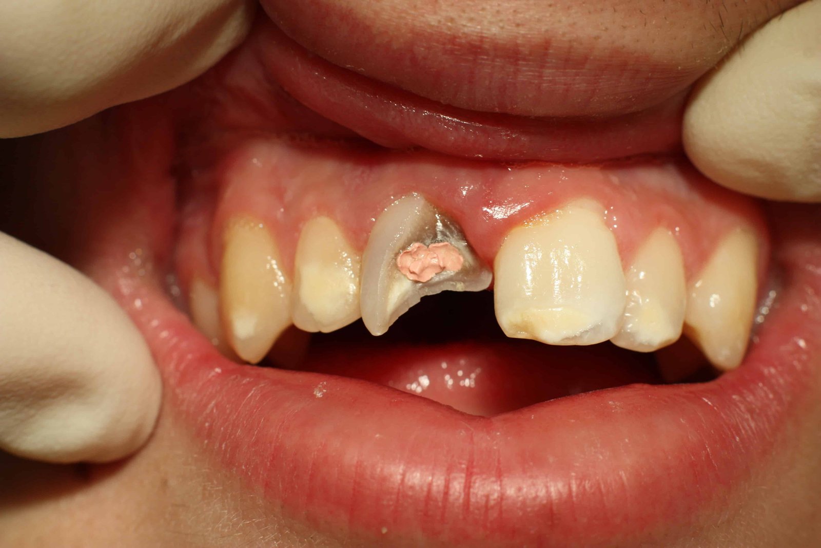 can chipped tooth be fixed