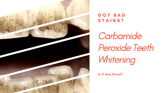 carbamide peroxide teeth whitening