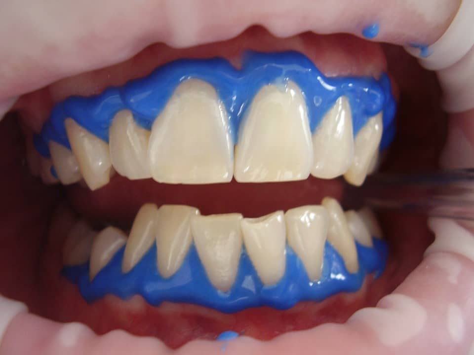 carbamide peroxide teeth whitening
