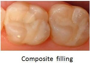 amalgam fillings dangerous