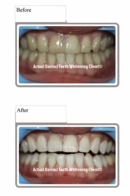 da-vinci-teeth-whitening-scam
