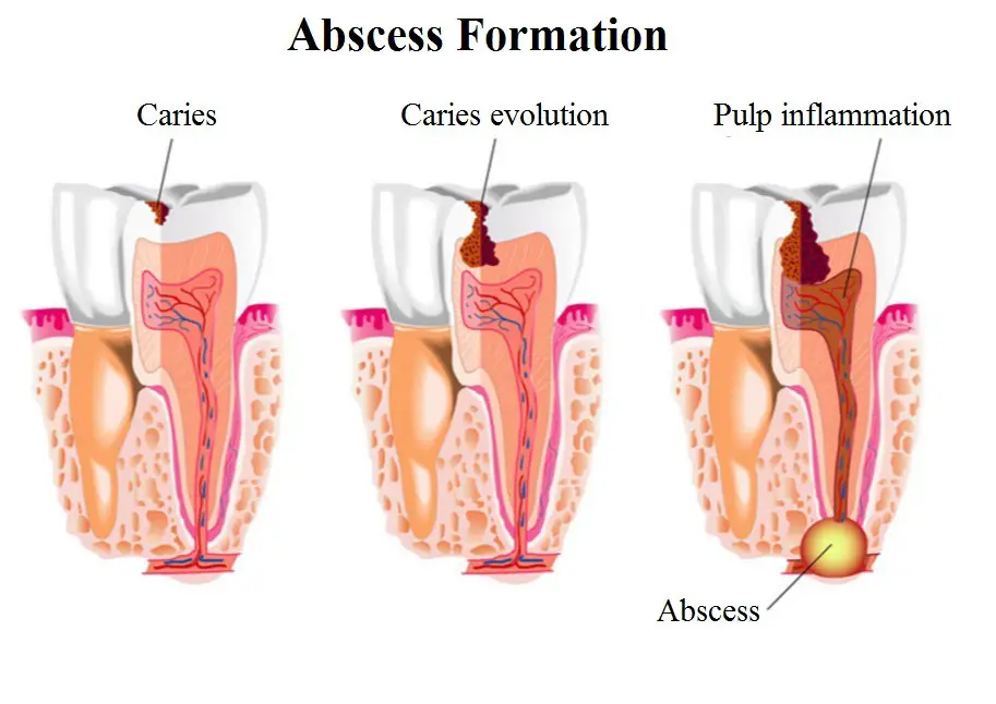 Abscess formation