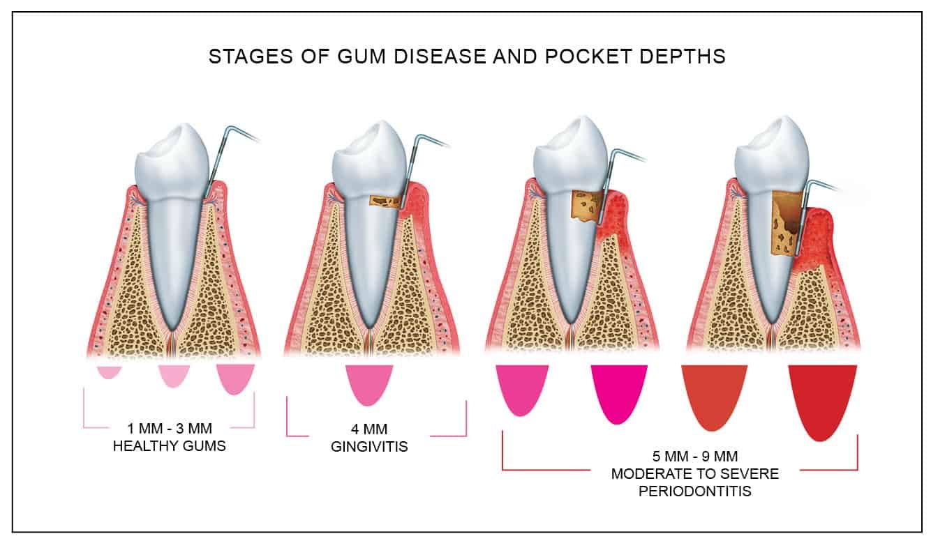 gum pocket depth chart